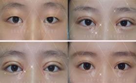 大同清木整形官網(wǎng)雙眼皮手術(shù)前后對(duì)比案例