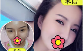 蕪湖壹加壹王心音做眼睛好嗎?看他割雙眼皮6 7 8毫米效果圖