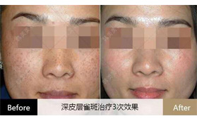 寧波韓美分享雀斑和黃褐斑治療方案及對比照