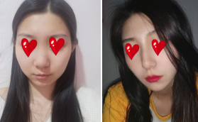 我還在上大學(xué)的時(shí)候攢錢去貴陽美貝爾做的假體隆鼻手術(shù)
