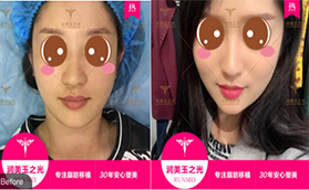 趁著價(jià)格優(yōu)惠我去北京潤(rùn)美玉之光做超皮秒激光祛斑手術(shù)