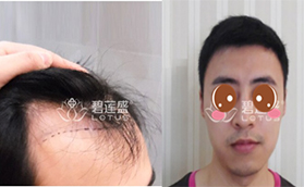 北京毛發(fā)種植哪家醫(yī)院做的好？北京碧蓮盛毛發(fā)種植多錢？