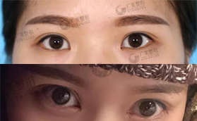 廣州廣美美雅整形自然無(wú)痕開(kāi)眼角前后案例對(duì)比照