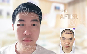 廣州仁健醫(yī)療美容門診部植發(fā)前后案例對(duì)比照