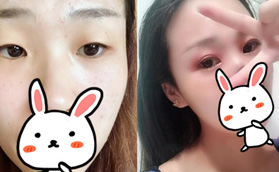 做雙眼皮一定要開(kāi)眼角嗎？反正我到常州美貝爾面診是做了