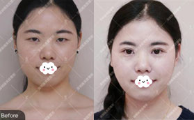 誰說深圳瑞芙臣割雙眼皮價格貴，我做后感覺性價比蠻高的