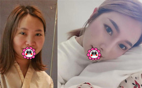 昆明藝星金輝擅長(zhǎng)做鼻修復(fù)找他做肋軟骨隆鼻恢復(fù)后果然美