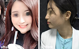 廣州聯(lián)合麗格醫(yī)療美容光子嫩膚色斑治療案例合集