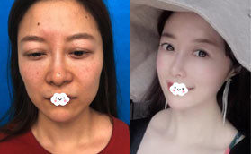 感覺(jué)深圳容術(shù)面部脂肪填充價(jià)格合理，做了科爾曼脂肪填充