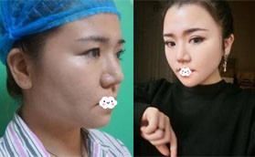 千萬別做光纖吸脂？我找深圳美芮王權(quán)做面部吸脂半年變化