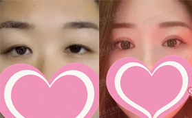 廣州華美整形醫(yī)院雙眼皮開眼角案例前后對(duì)比照