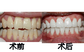長沙星雅整形醫(yī)院牙齒冷光美白案例