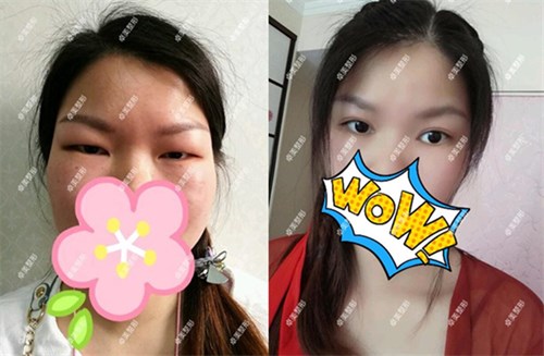 腫眼泡的我預約武漢卓美吳秀英做雙眼皮后發(fā)現(xiàn)技術很靠譜