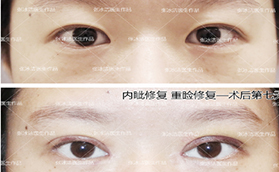 北京張冰潔修復(fù)雙眼皮怎么樣？案例及價(jià)格表看技術(shù)亮點(diǎn)