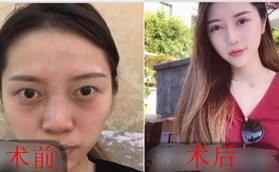 做鼻綜合有沒有后遺癥？看我在南京瑧顏做的效果怎么樣