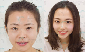 北京日式雙眼皮哪家好?在領(lǐng)醫(yī)做日式無痕雙眼皮效果獲好評