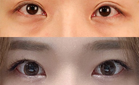 韓國TS整形外科的眼修復怎么樣?李相均雙眼皮整形特點如下
